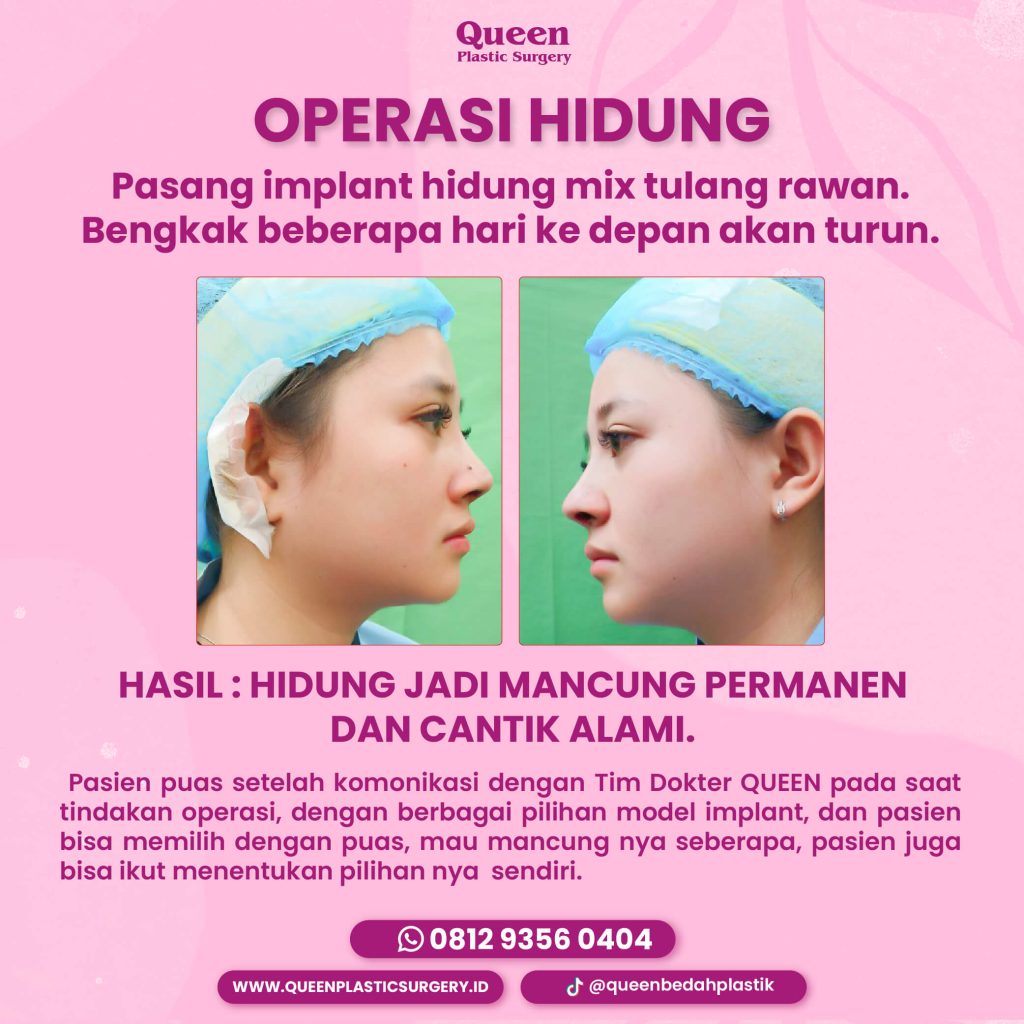Operasi Hidung Terbaik di Queen Plastic Surgery