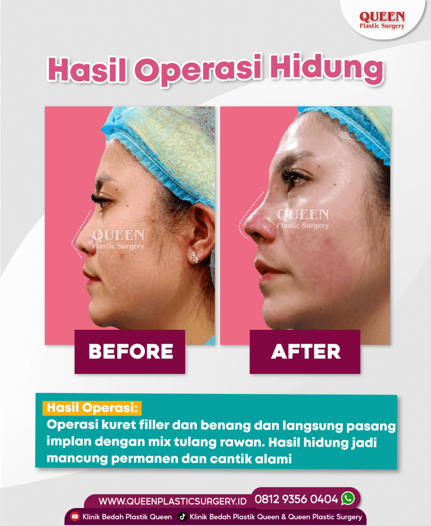 Operasi hidung pakai tulang telinga di Queen Plastic Surgery