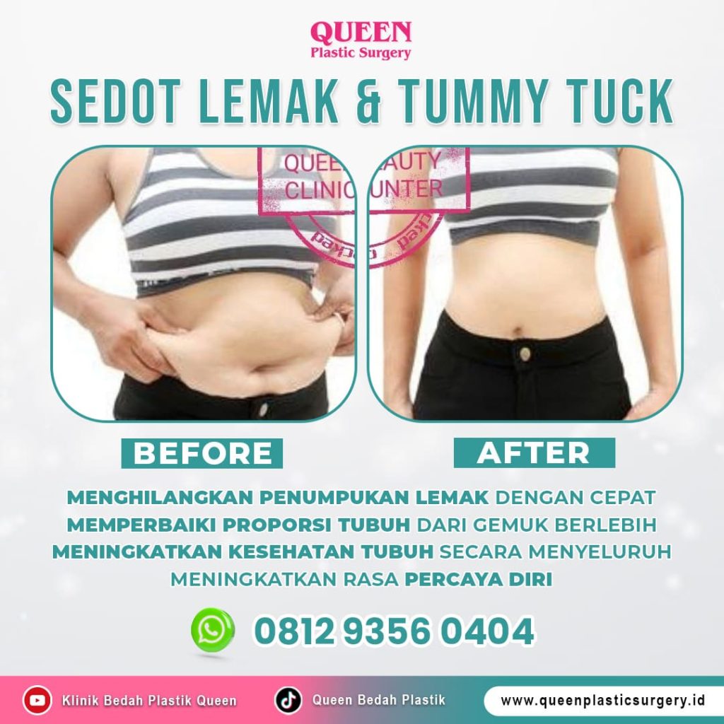 Operasi sedot lemak harga di Queen Plastic Surgery