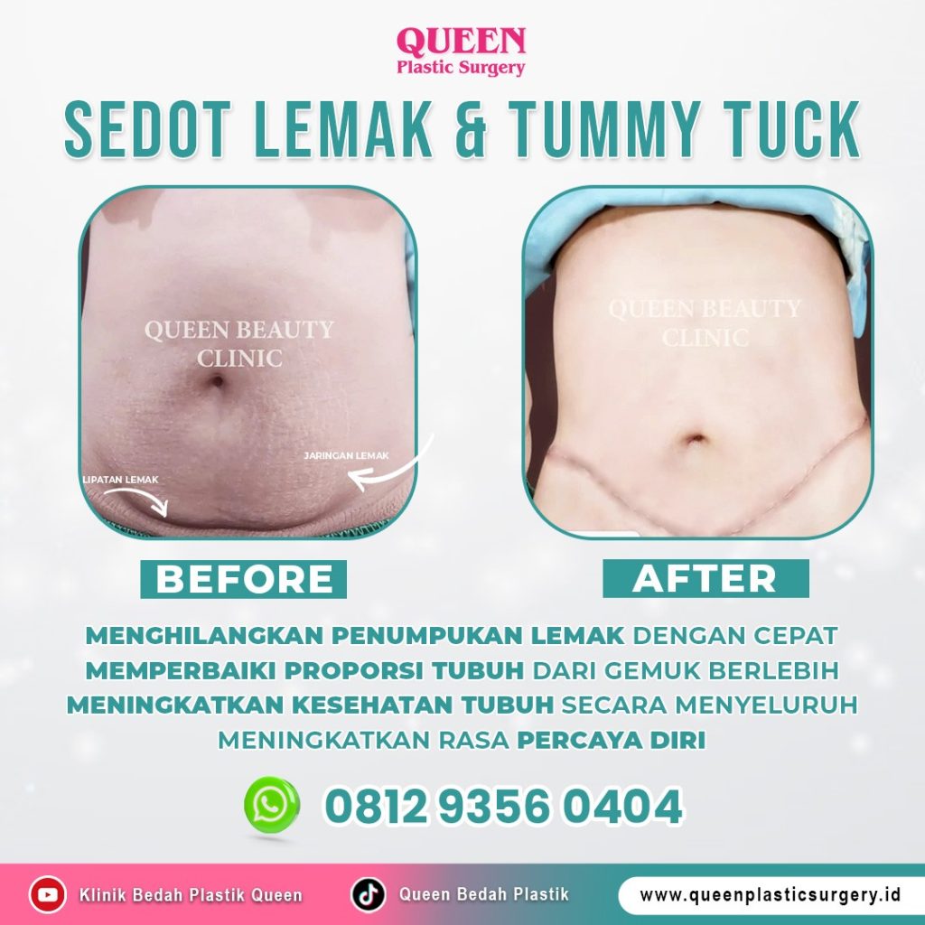 Operasi sedot lemak harga di Queen Plastic Surgery