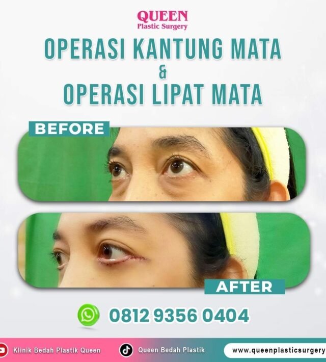 operasi kantung mata