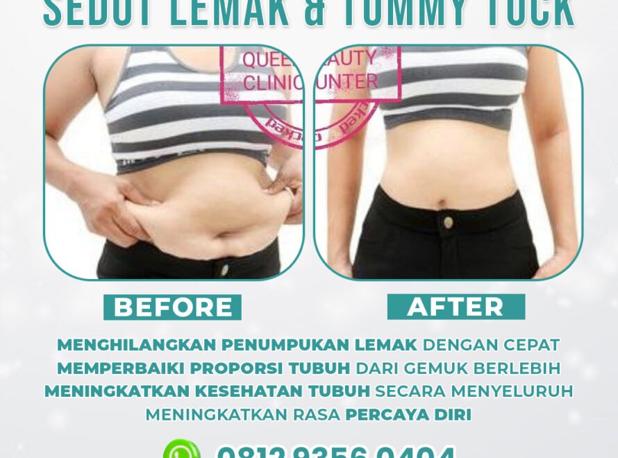 Operasi sedot lemak